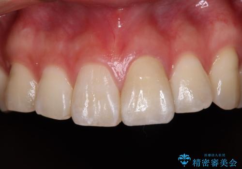 変色した前歯の詰め物　オールセラミッククラウンで本物の前歯のようにの症例 治療後