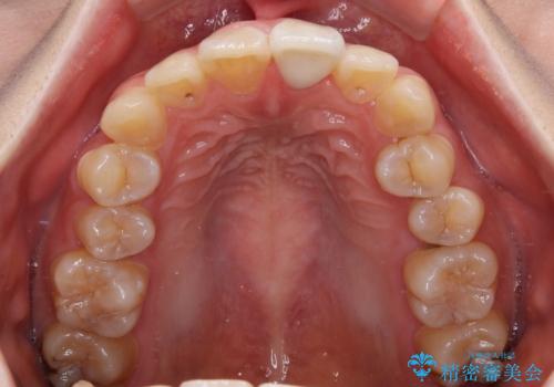 変色した前歯の詰め物　オールセラミッククラウンで本物の前歯のようにの治療後