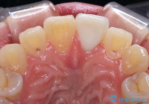変色した前歯の詰め物　オールセラミッククラウンで本物の前歯のようにの治療後