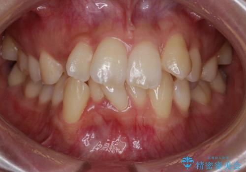 がたつきが強いガチャ歯。埋伏歯抜歯+矯正。すごいところに犬歯が埋まっていたのを抜いてワイヤー矯正治療の症例 治療前