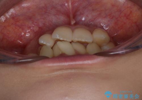 がたつきが強いガチャ歯。埋伏歯抜歯+矯正。すごいところに犬歯が埋まっていたのを抜いてワイヤー矯正治療の治療前