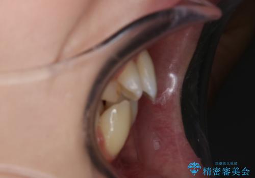 がたつきが強いガチャ歯。埋伏歯抜歯+矯正。すごいところに犬歯が埋まっていたのを抜いてワイヤー矯正治療の治療前