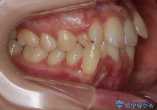 がたつきが強いガチャ歯。埋伏歯抜歯+矯正。すごいところに犬歯が埋まっていたのを抜いてワイヤー矯正治療の治療前