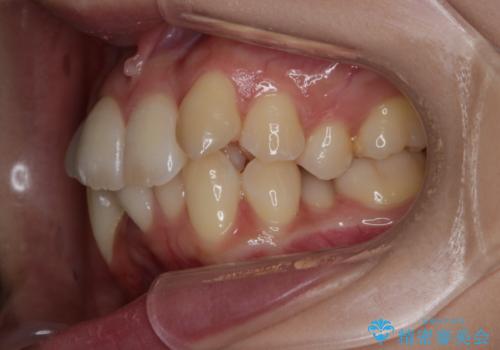 がたつきが強いガチャ歯。埋伏歯抜歯+矯正。すごいところに犬歯が埋まっていたのを抜いてワイヤー矯正治療の治療前