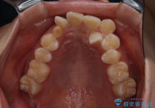 がたつきが強いガチャ歯。埋伏歯抜歯+矯正。すごいところに犬歯が埋まっていたのを抜いてワイヤー矯正治療の治療前