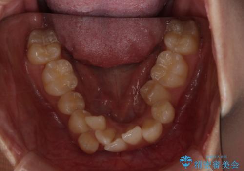 がたつきが強いガチャ歯。埋伏歯抜歯+矯正。すごいところに犬歯が埋まっていたのを抜いてワイヤー矯正治療の治療前