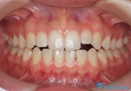 咬んでも前歯が閉じない　矯正治療で見た目を含めて改善の治療前