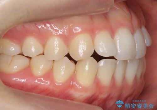 咬んでも前歯が閉じない　矯正治療で見た目を含めて改善の治療前
