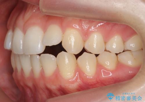 咬んでも前歯が閉じない 矯正治療で見た目を含めて改善の治療前