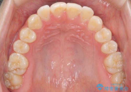 咬んでも前歯が閉じない 矯正治療で見た目を含めて改善の治療前