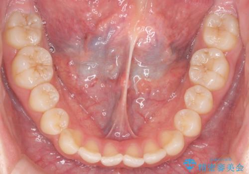 咬んでも前歯が閉じない 矯正治療で見た目を含めて改善の治療前