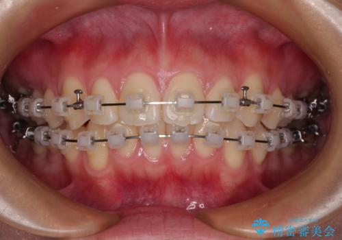 デコボコをワイヤー装置で改善 短期間で綺麗な仕上がりにの治療中