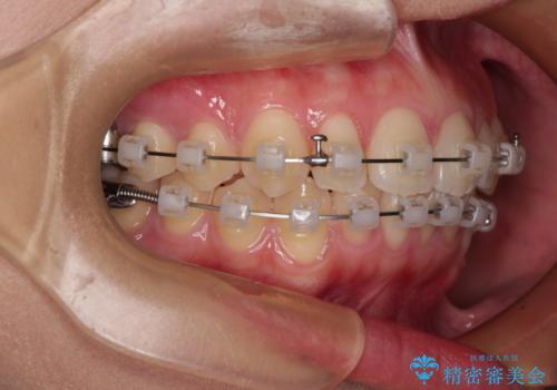 デコボコをワイヤー装置で改善 短期間で綺麗な仕上がりにの治療中