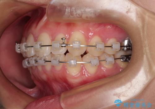 デコボコをワイヤー装置で改善 短期間で綺麗な仕上がりにの治療中