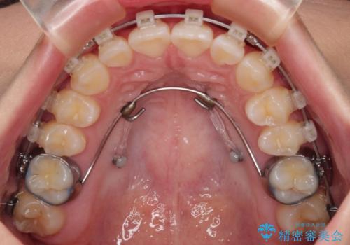 デコボコをワイヤー装置で改善 短期間で綺麗な仕上がりにの治療中