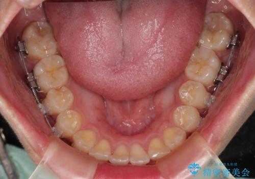 デコボコをワイヤー装置で改善 短期間で綺麗な仕上がりにの治療中