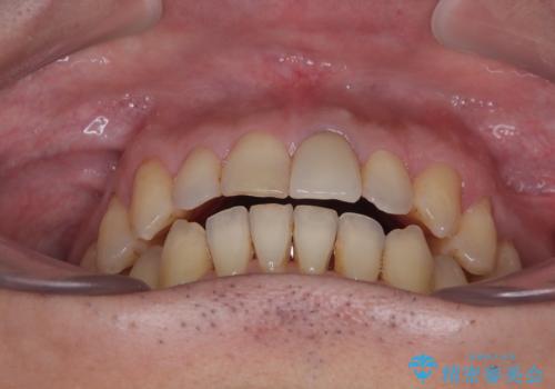 外科手術を検討? 過大な開咬をワイヤー装置とインビザラインで劇的に改善するの治療後