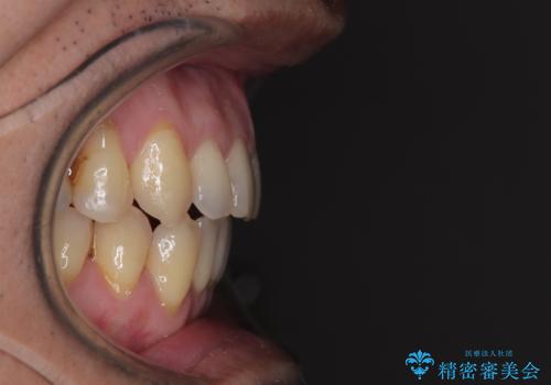 外科手術を検討? 過大な開咬をワイヤー装置とインビザラインで劇的に改善するの治療後