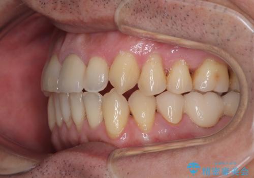 外科手術を検討? 過大な開咬をワイヤー装置とインビザラインで劇的に改善するの治療後