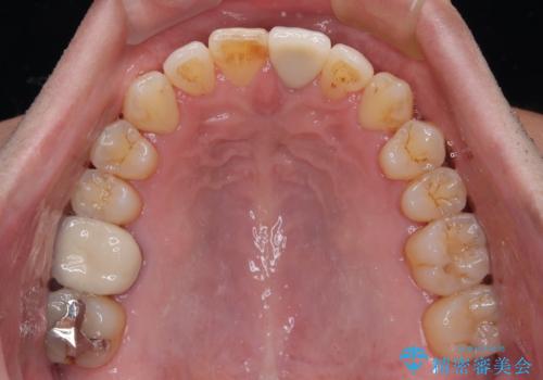 外科手術を検討? 過大な開咬をワイヤー装置とインビザラインで劇的に改善するの治療後