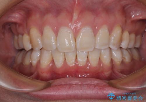 上顎前突で口が閉じにくい ワイヤー装置での抜歯矯正の治療後