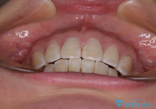 上顎前突で口が閉じにくい ワイヤー装置での抜歯矯正の治療後