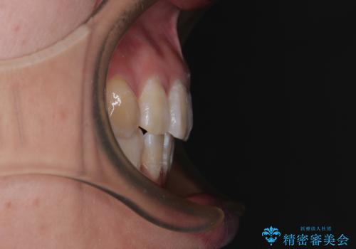 上顎前突で口が閉じにくい　ワイヤー装置での抜歯矯正の症例 治療後
