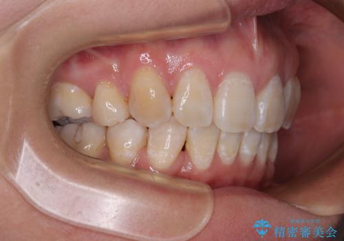 上顎前突で口が閉じにくい　ワイヤー装置での抜歯矯正の治療後