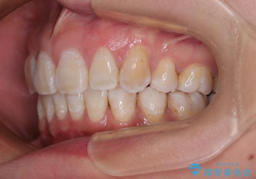 上顎前突で口が閉じにくい ワイヤー装置での抜歯矯正の治療後