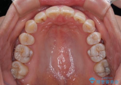 上顎前突で口が閉じにくい　ワイヤー装置での抜歯矯正の治療後