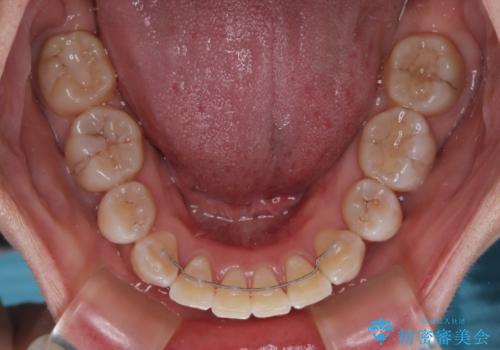 上顎前突で口が閉じにくい ワイヤー装置での抜歯矯正の治療後