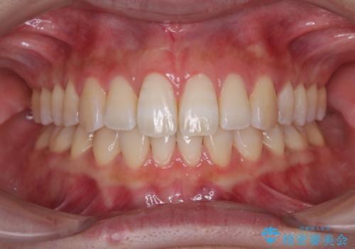 下顎前歯の欠損歯列　ワイヤー装置での矯正治療の症例 治療後