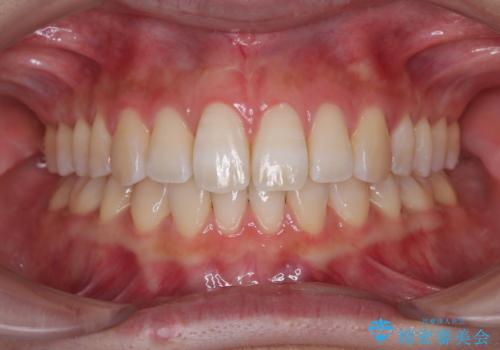 下顎前歯の欠損歯列 ワイヤー装置での矯正治療の治療後