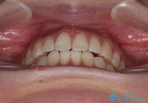 下顎前歯の欠損歯列　ワイヤー装置での矯正治療の治療後