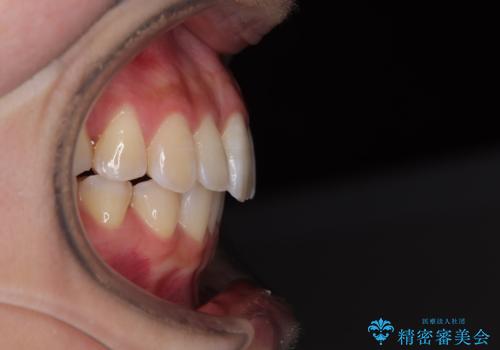 下顎前歯の欠損歯列 ワイヤー装置での矯正治療の治療後