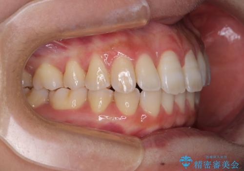 下顎前歯の欠損歯列 ワイヤー装置での矯正治療の治療後