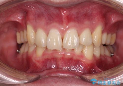 八重歯の抜歯矯正 インビザラインを用いて気になる歯並びを改善の治療中