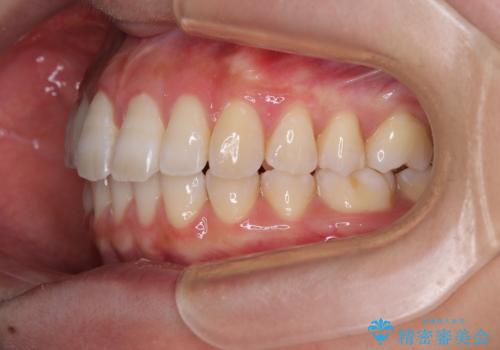 下顎前歯の欠損歯列 ワイヤー装置での矯正治療の治療後