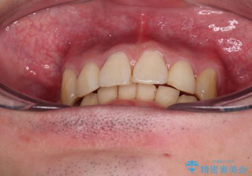 八重歯の抜歯矯正 インビザラインを用いて気になる歯並びを改善の治療中