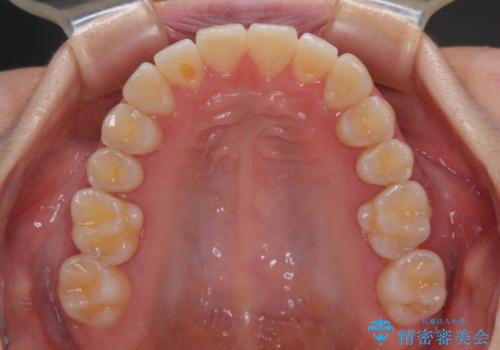 下顎前歯の欠損歯列 ワイヤー装置での矯正治療の治療後