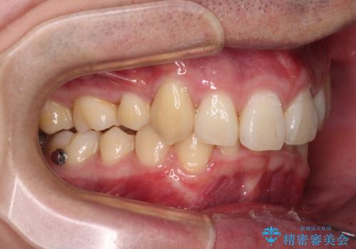 八重歯の抜歯矯正　インビザラインを用いて気になる歯並びを改善の治療中