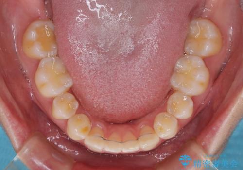 下顎前歯の欠損歯列　ワイヤー装置での矯正治療の治療後