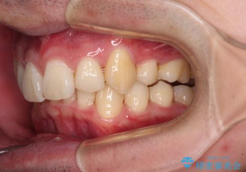 八重歯の抜歯矯正　インビザラインを用いて気になる歯並びを改善の治療中