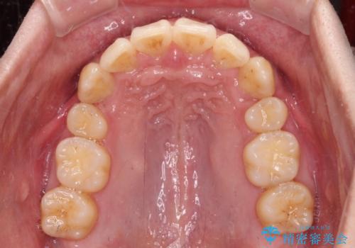 八重歯の抜歯矯正 インビザラインを用いて気になる歯並びを改善の治療中