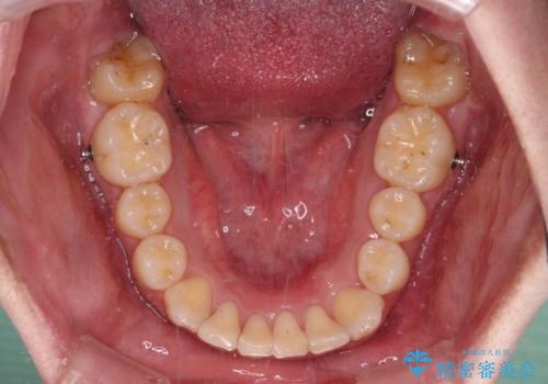 八重歯の抜歯矯正 インビザラインを用いて気になる歯並びを改善の治療中