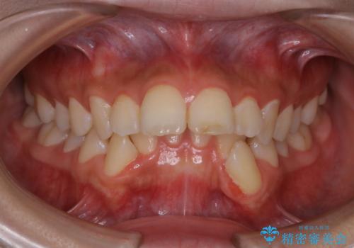 出っ歯と深い噛み合わせ:抜歯矯正で口元スッキリ!の症例 治療前