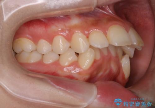 出っ歯と深い噛み合わせ:抜歯矯正で口元スッキリ!の治療前