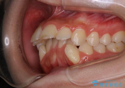 出っ歯と深い噛み合わせ:抜歯矯正で口元スッキリ!の治療前