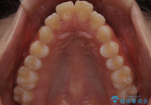 出っ歯と深い噛み合わせ:抜歯矯正で口元スッキリ!の治療前