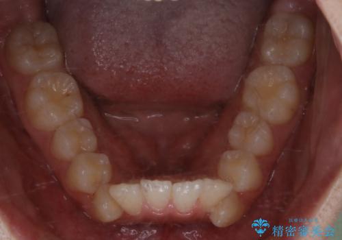 出っ歯と深い噛み合わせ:抜歯矯正で口元スッキリ!の治療前